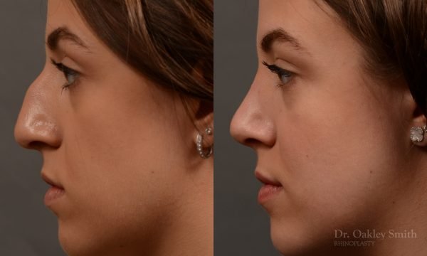 433 rhinoplasty, dr oakley smith, toronto, top surgeon, nose job