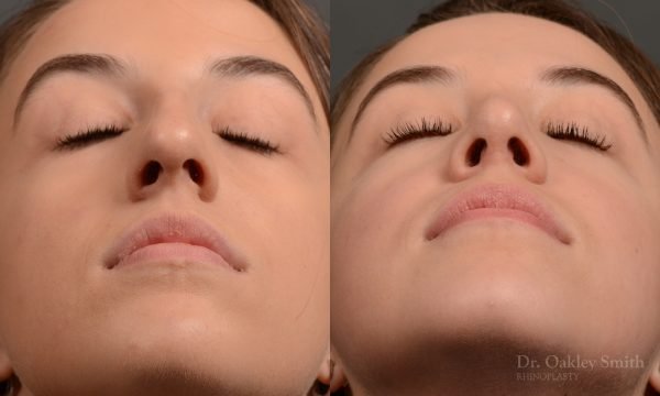 433 rhinoplasty, dr oakley smith, toronto, top surgeon, nose job