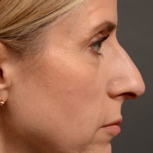 434 rhinoplasty, dr oakley smith, toronto, top surgeon, nose job