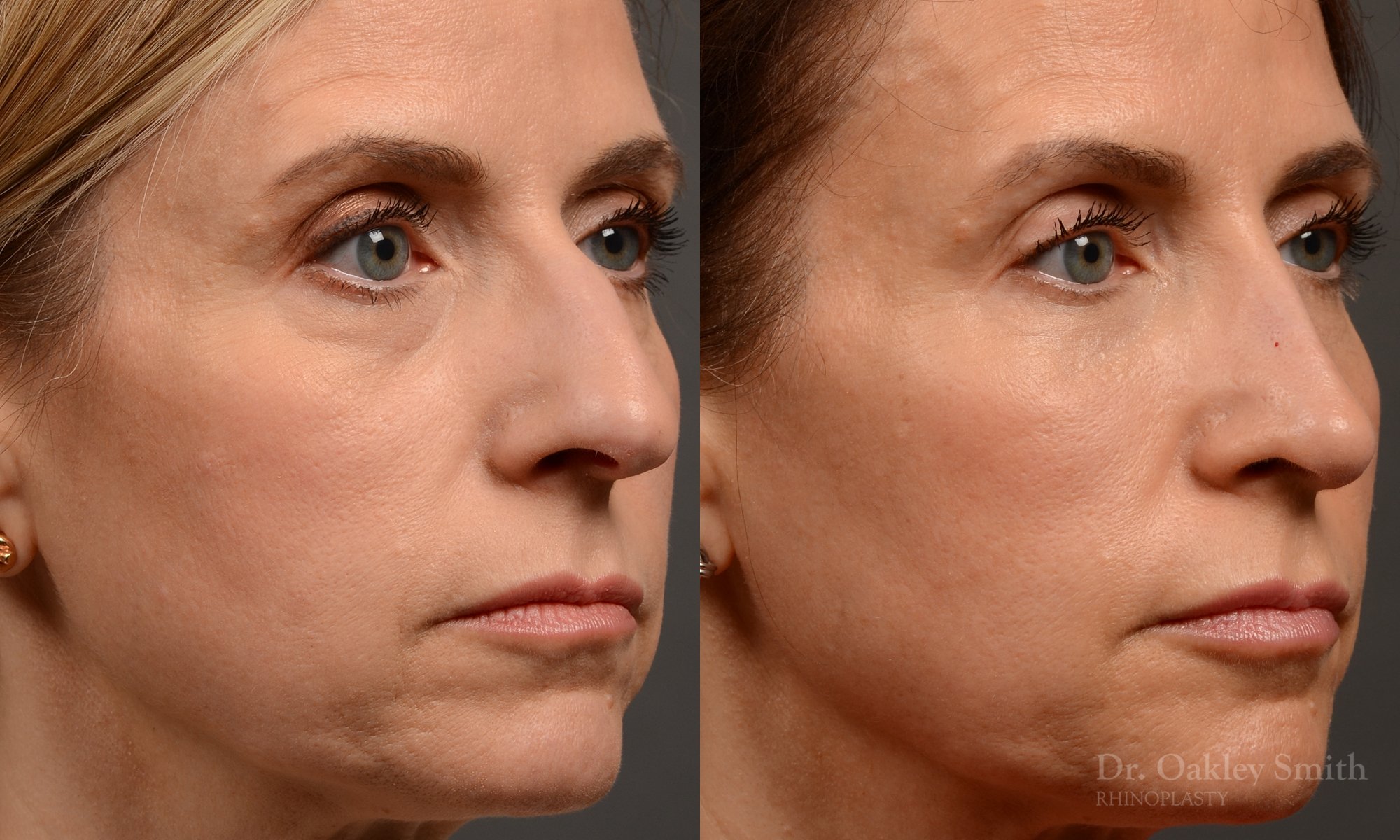 434 rhinoplasty, dr oakley smith, toronto, top surgeon, nose job