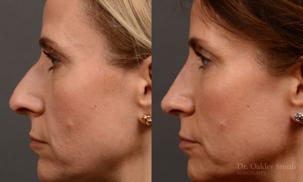 434 rhinoplasty, dr oakley smith, toronto, top surgeon, nose job