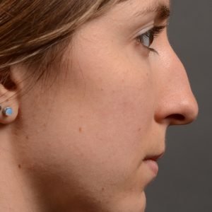 436 rhinoplasty, dr oakley smith, toronto, top surgeon, nose job