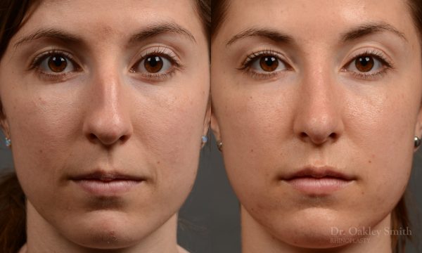 436 rhinoplasty, dr oakley smith, toronto, top surgeon, nose job