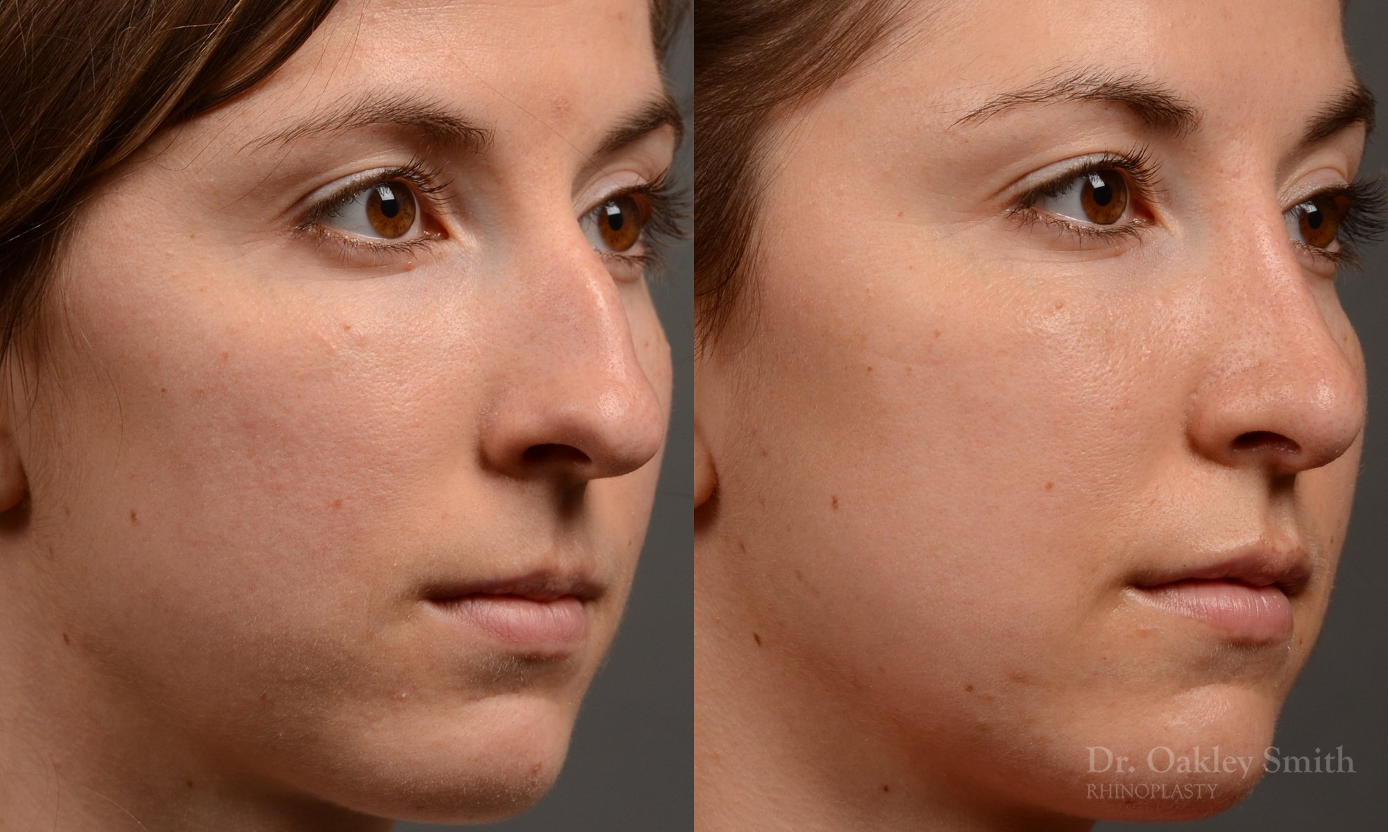 436 rhinoplasty, dr oakley smith, toronto, top surgeon, nose job