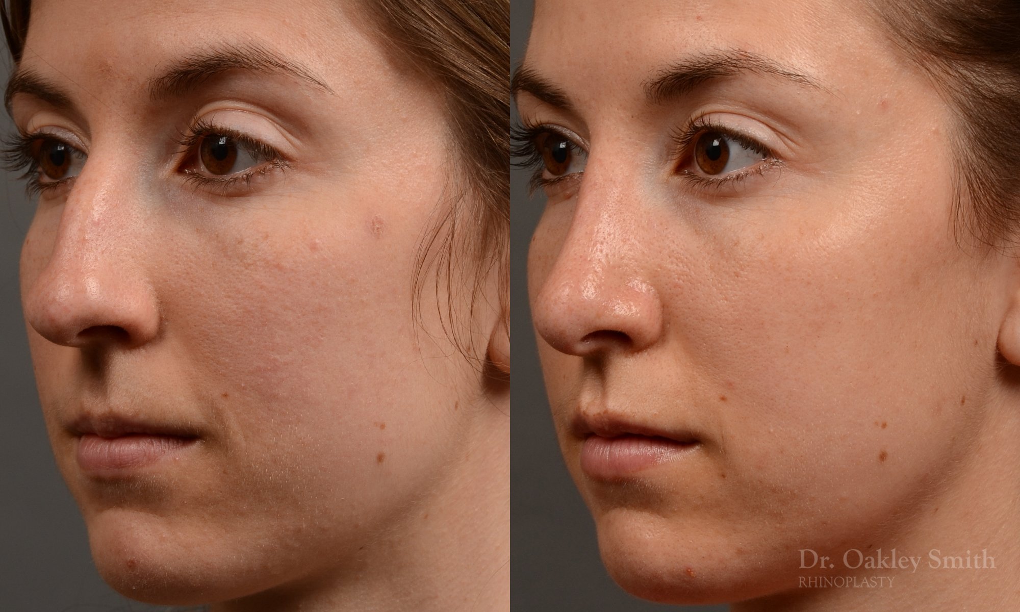 436 rhinoplasty, dr oakley smith, toronto, top surgeon, nose job