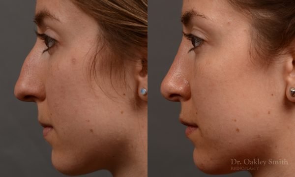 436 rhinoplasty, dr oakley smith, toronto, top surgeon, nose job