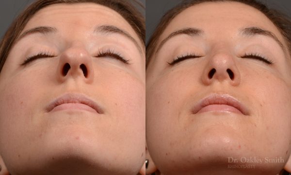 436 rhinoplasty, dr oakley smith, toronto, top surgeon, nose job