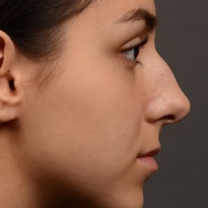 444 rhinoplasty, dr oakley smith, toronto, top surgeon, nose job