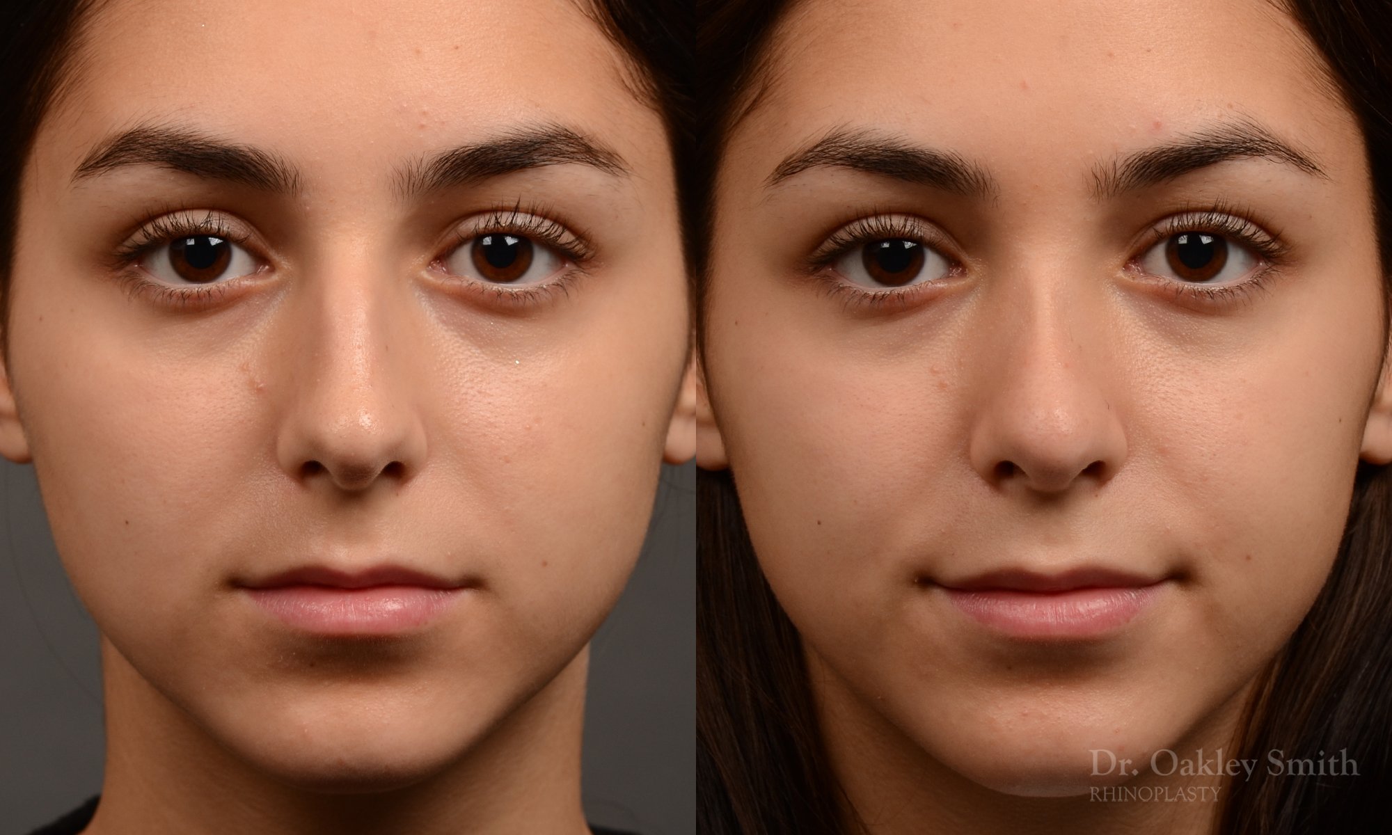 444 rhinoplasty, dr oakley smith, toronto, top surgeon, nose job