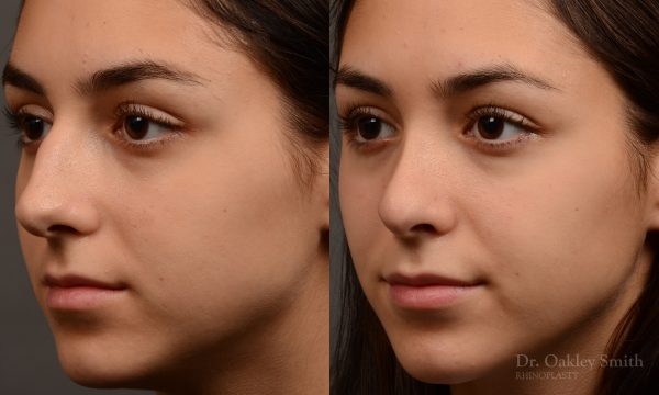 444 rhinoplasty, dr oakley smith, toronto, top surgeon, nose job