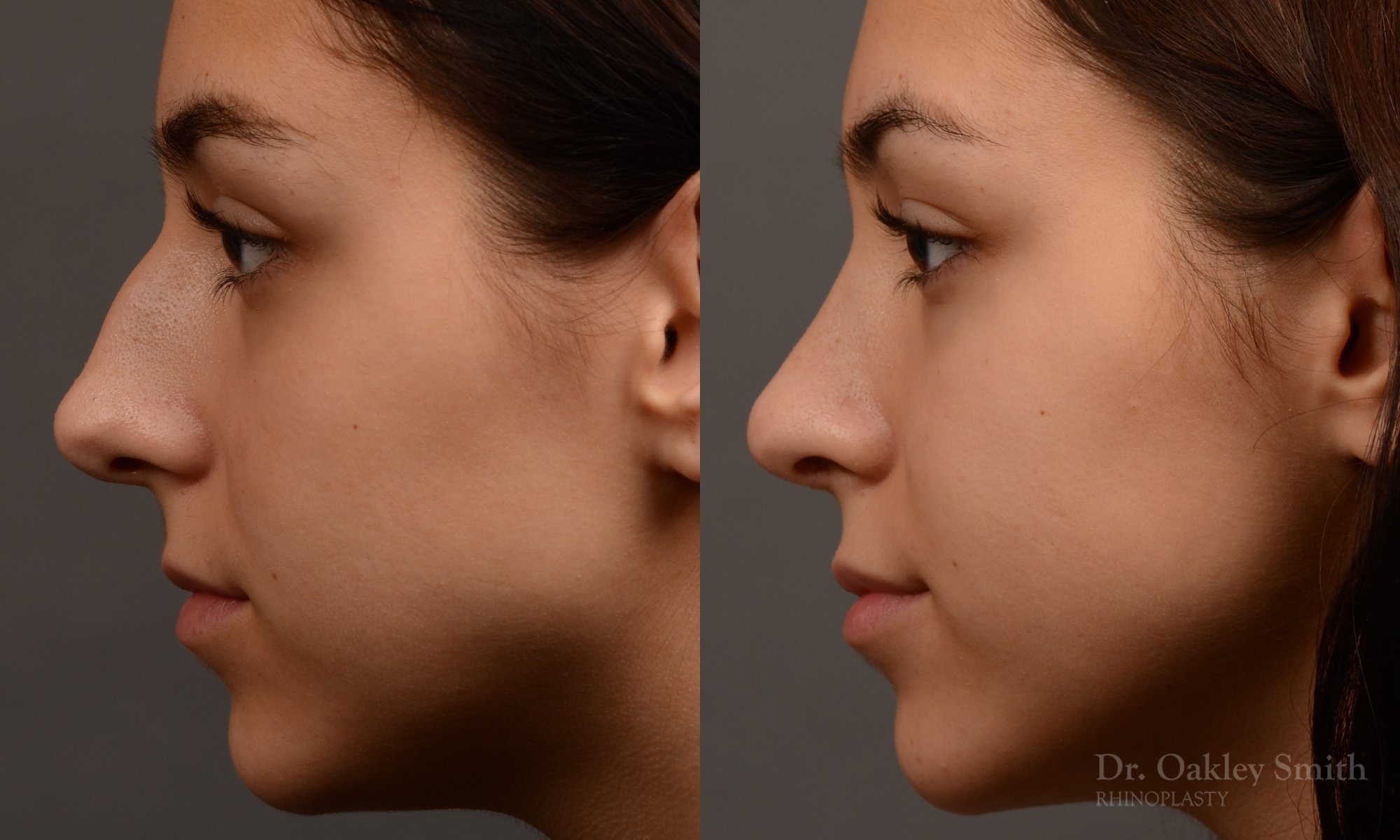 444 rhinoplasty, dr oakley smith, toronto, top surgeon, nose job