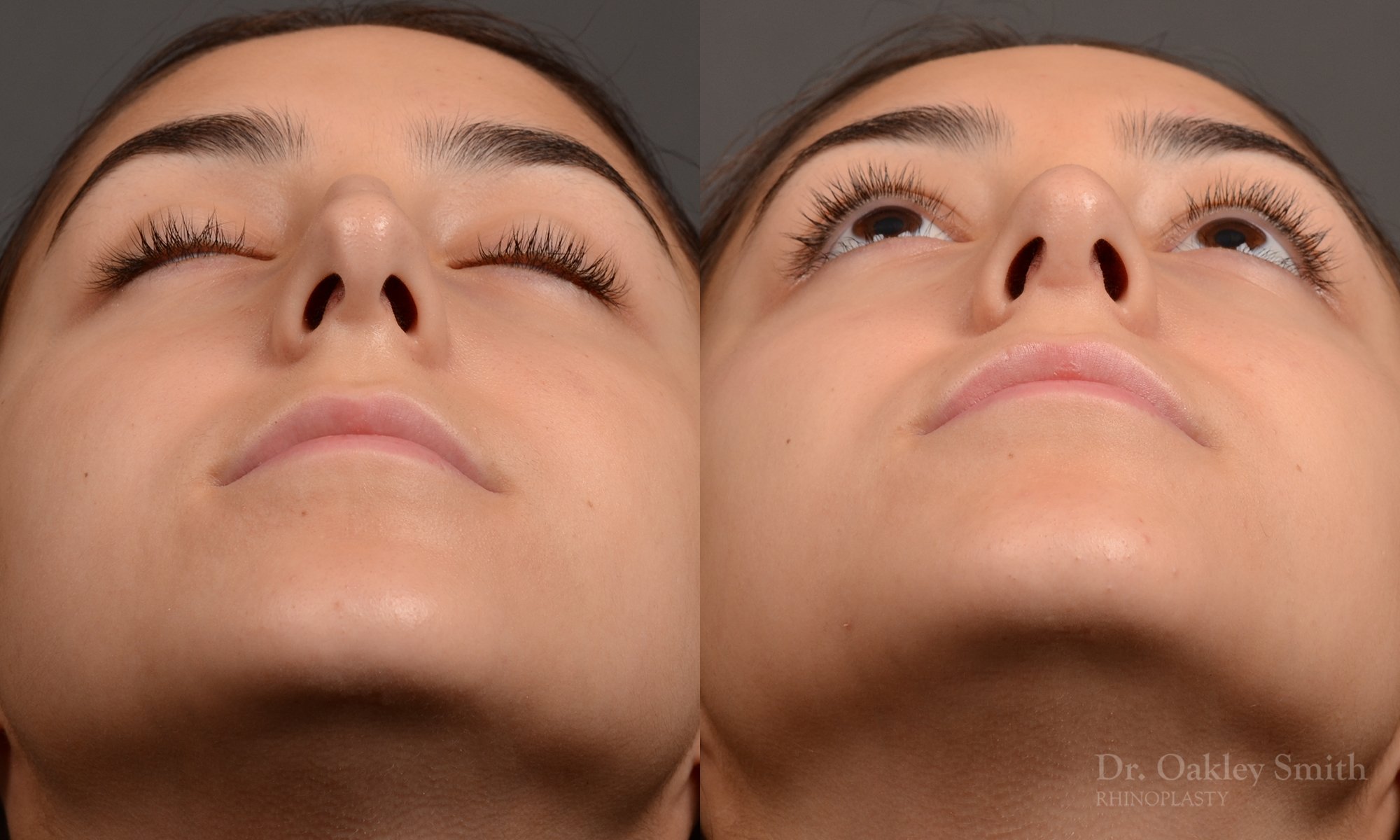 444 rhinoplasty, dr oakley smith, toronto, top surgeon, nose job