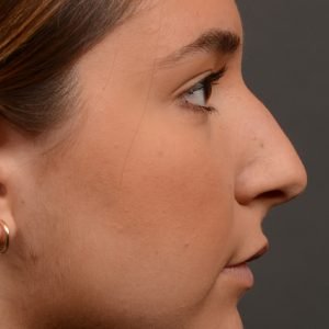 445 rhinoplasty, dr oakley smith, toronto, top surgeon, nose job