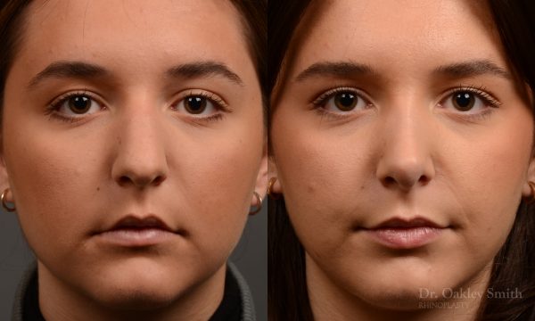 445 rhinoplasty, dr oakley smith, toronto, top surgeon, nose job