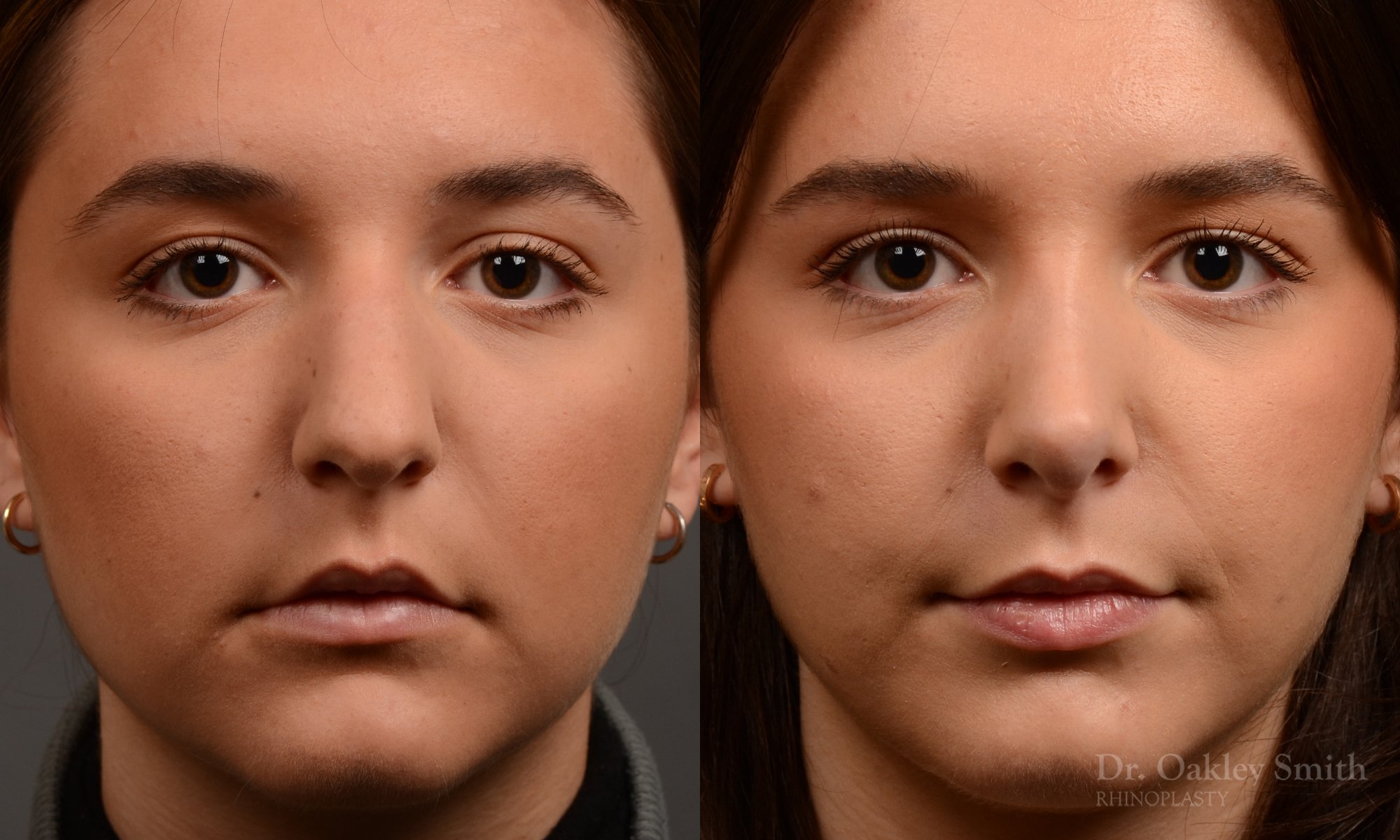 445 rhinoplasty, dr oakley smith, toronto, top surgeon, nose job