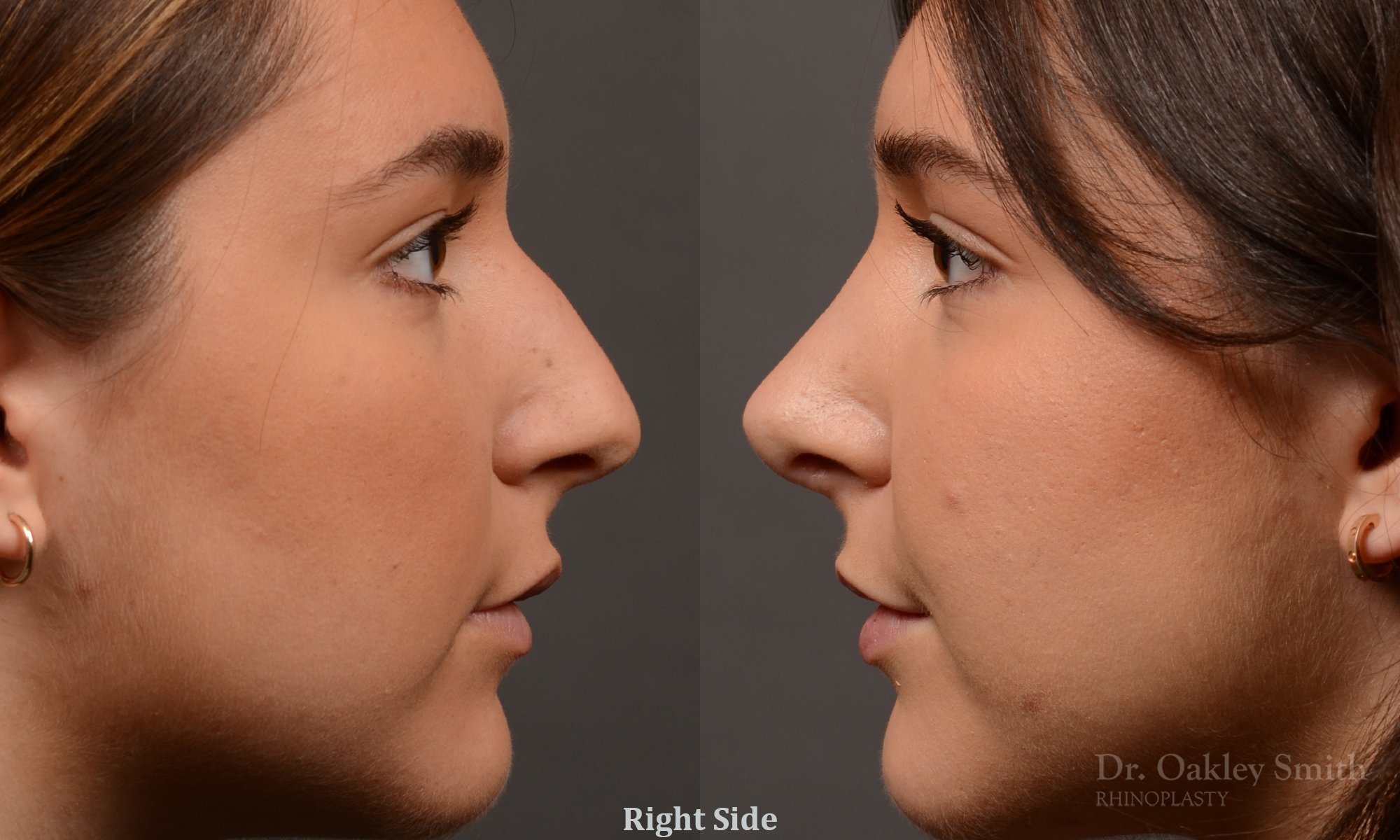 445 rhinoplasty, dr oakley smith, toronto, top surgeon, nose job