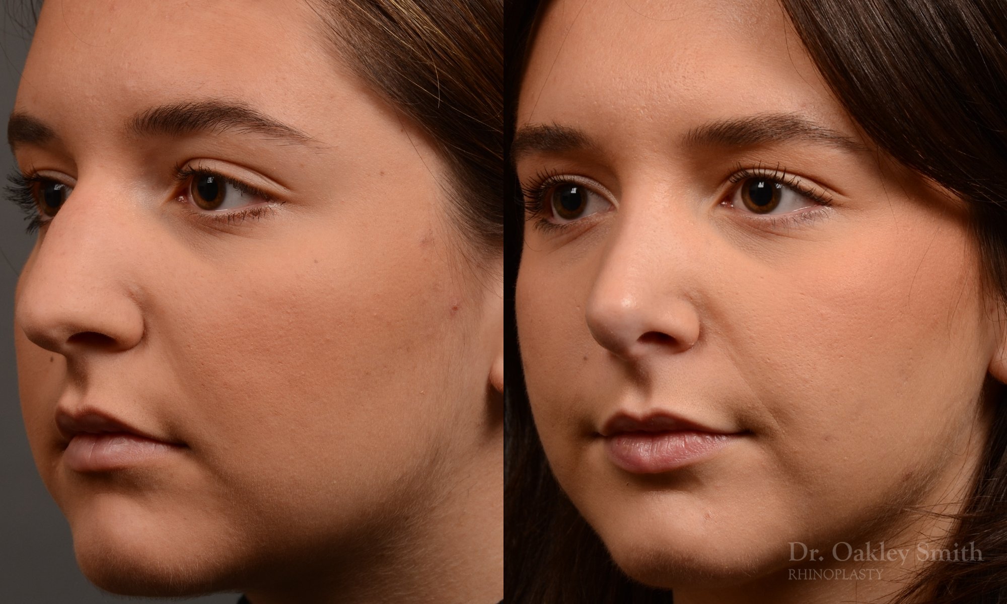 445 rhinoplasty, dr oakley smith, toronto, top surgeon, nose job
