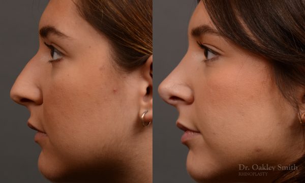 445 rhinoplasty, dr oakley smith, toronto, top surgeon, nose job