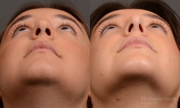 445 rhinoplasty, dr oakley smith, toronto, top surgeon, nose job