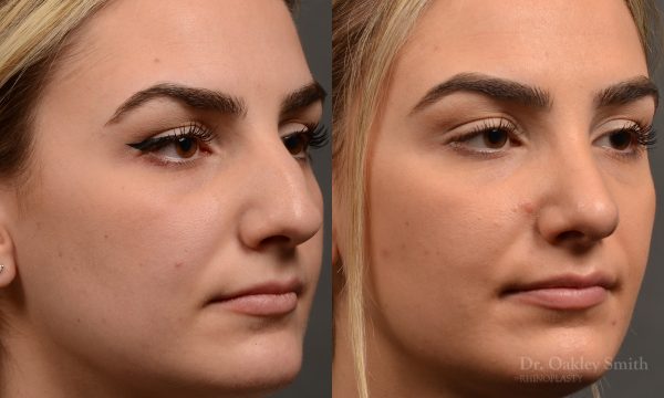 446 rhinoplasty, dr oakley smith, toronto, top surgeon, nose job