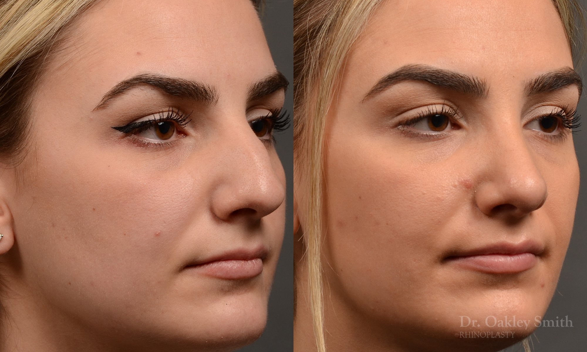 446 rhinoplasty, dr oakley smith, toronto, top surgeon, nose job