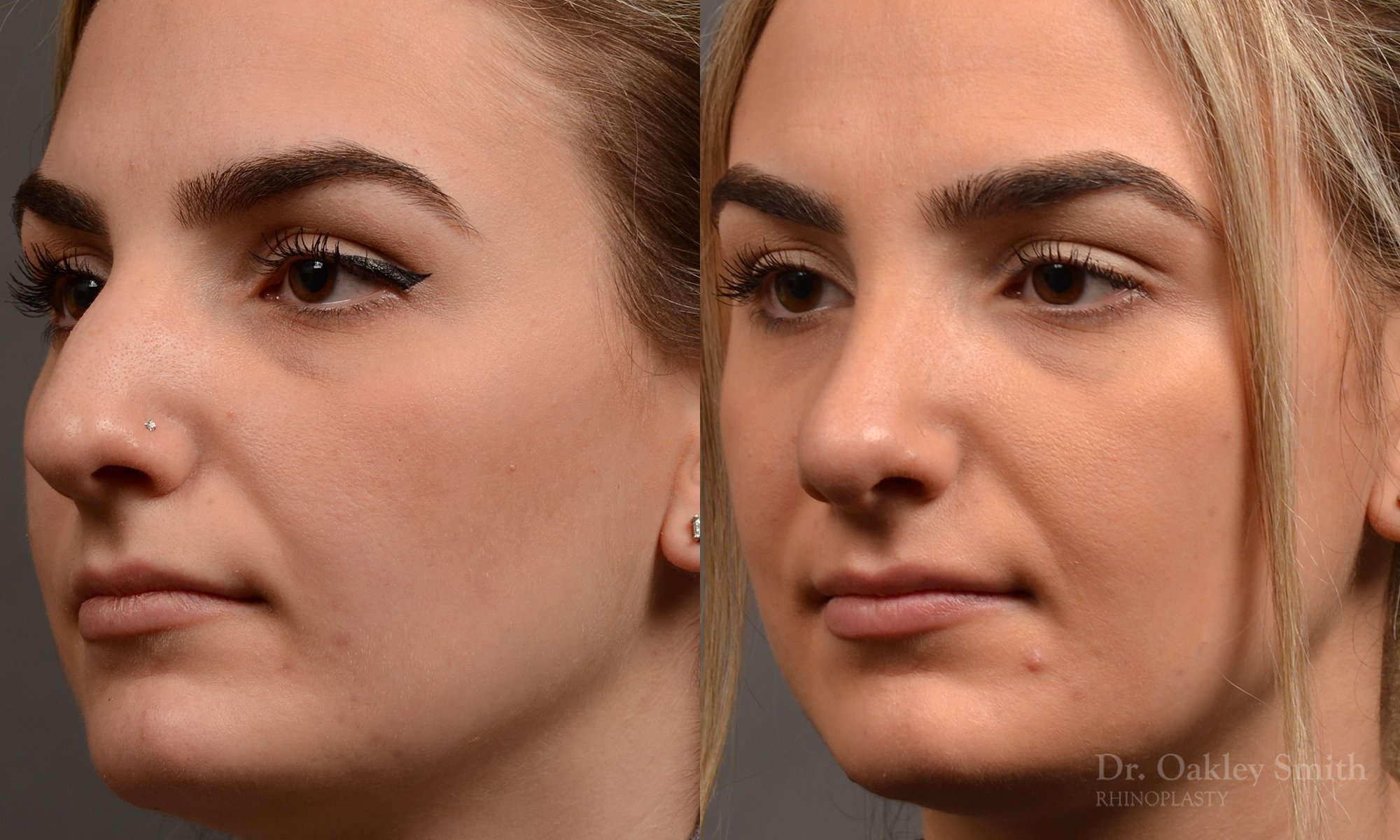 446 rhinoplasty, dr oakley smith, toronto, top surgeon, nose job