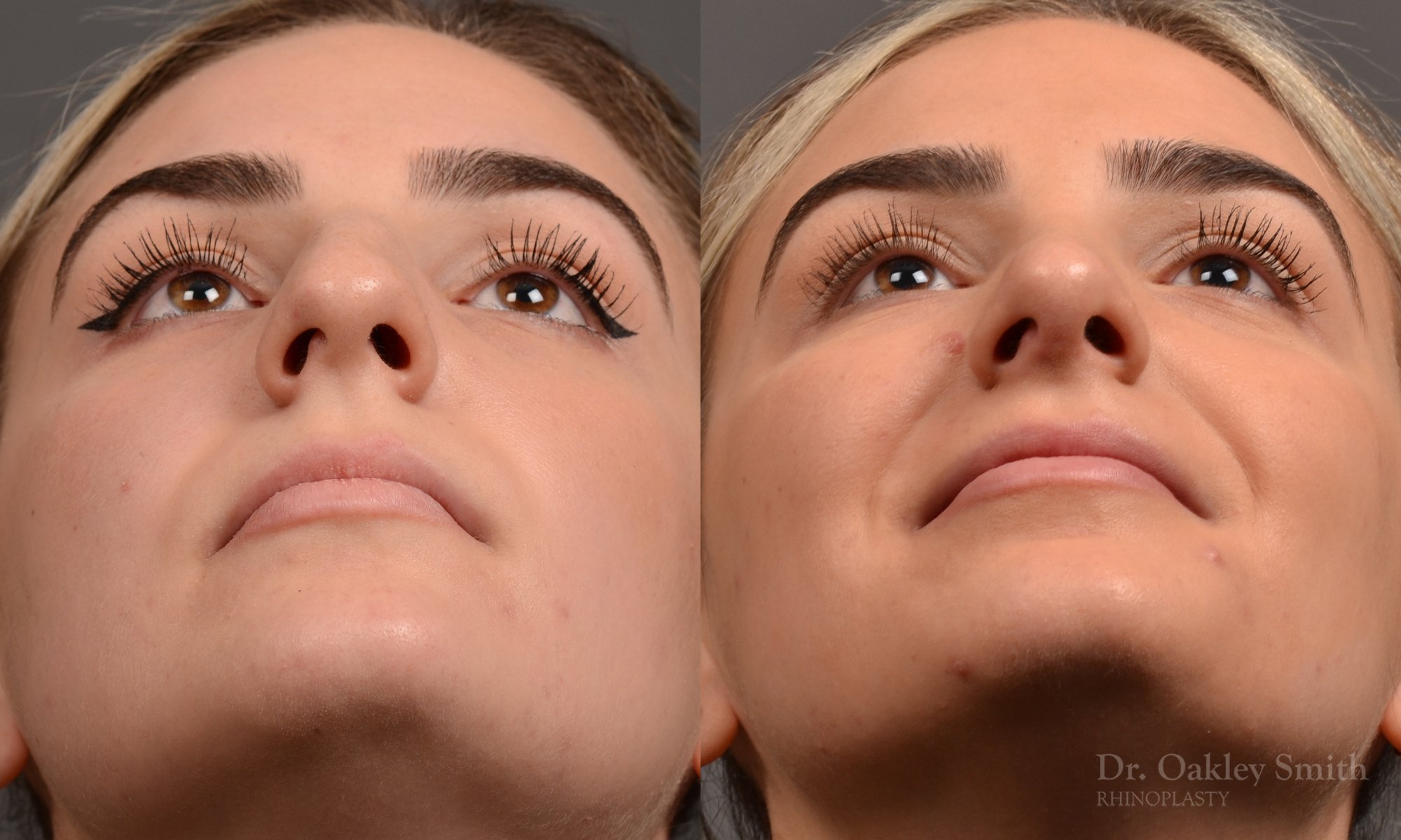 446 rhinoplasty, dr oakley smith, toronto, top surgeon, nose job