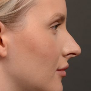 447 rhinoplasty, dr oakley smith, toronto, top surgeon, nose job
