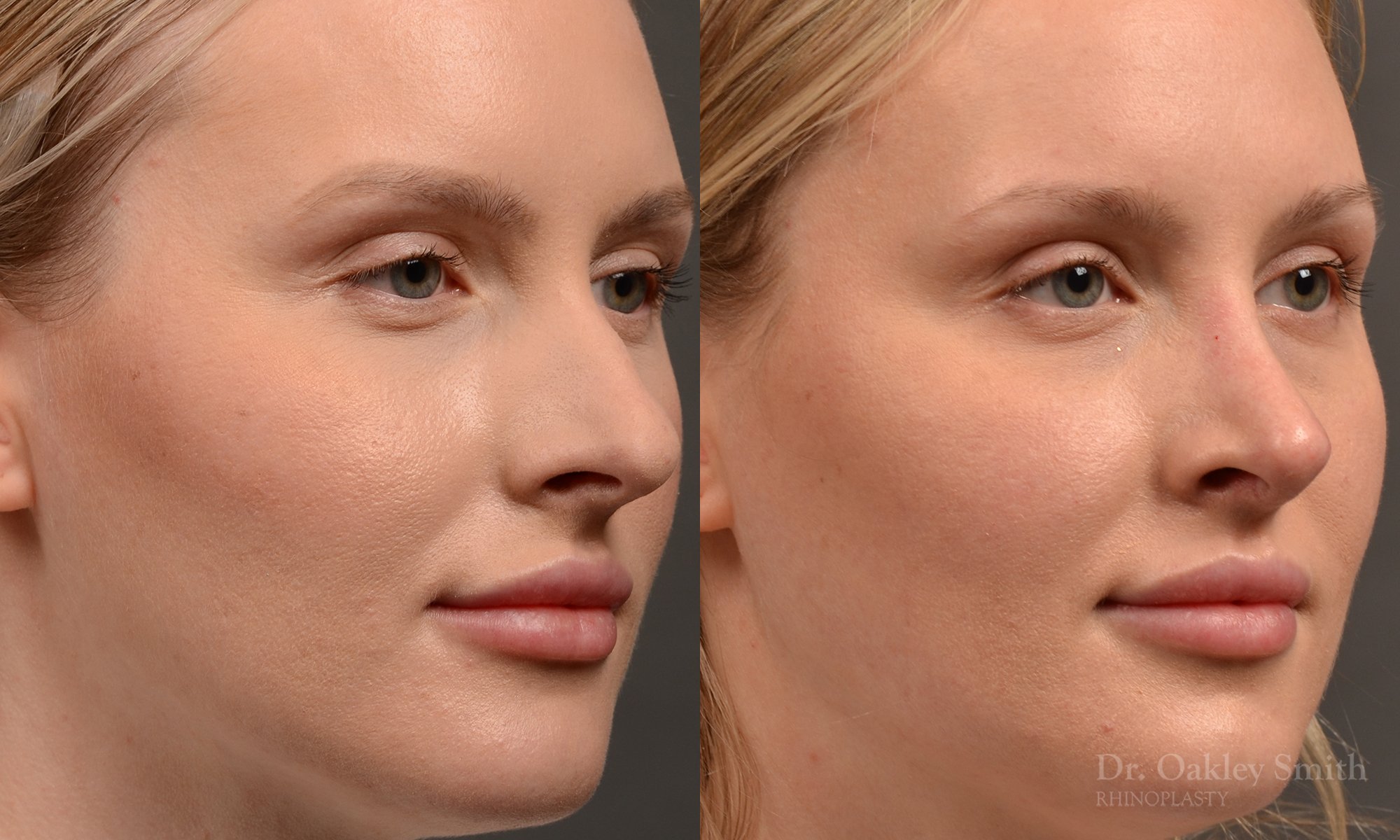 447 rhinoplasty, dr oakley smith, toronto, top surgeon, nose job