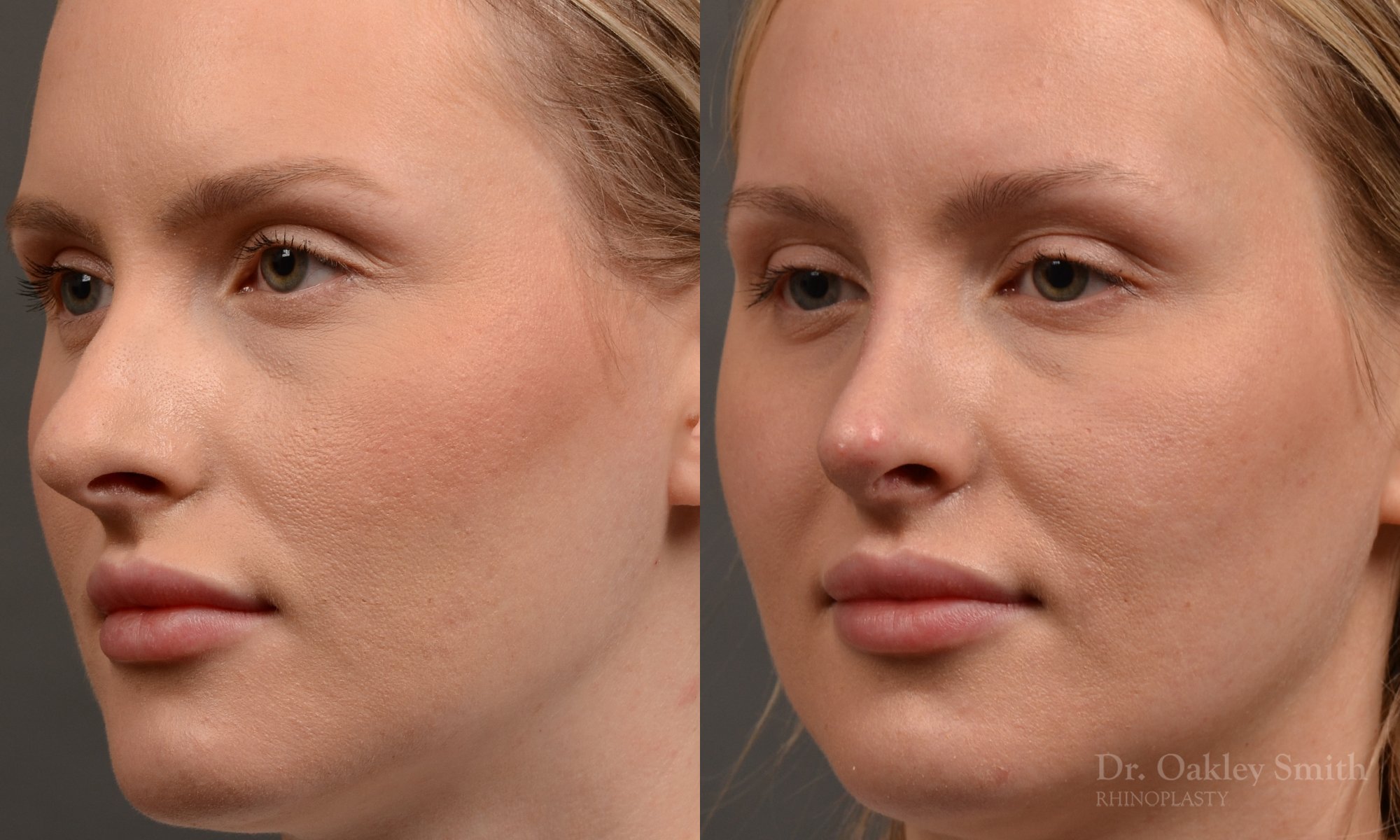 447 rhinoplasty, dr oakley smith, toronto, top surgeon, nose job