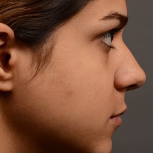 Rhinoplasty - Rhinoplasty Before and After Case 448