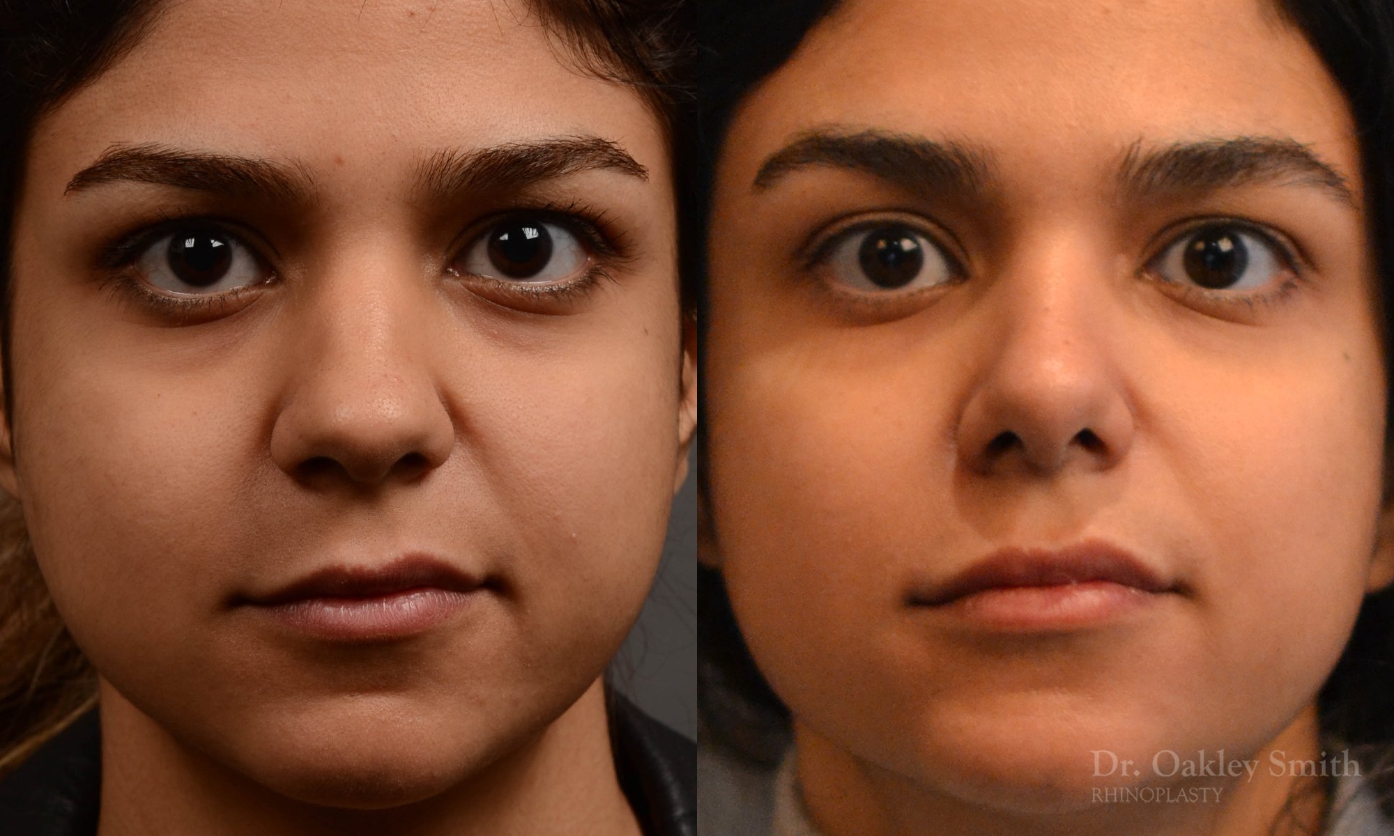 frontal view surgery
