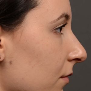 449 rhinoplasty, dr oakley smith, toronto, top surgeon, rhino, nose job