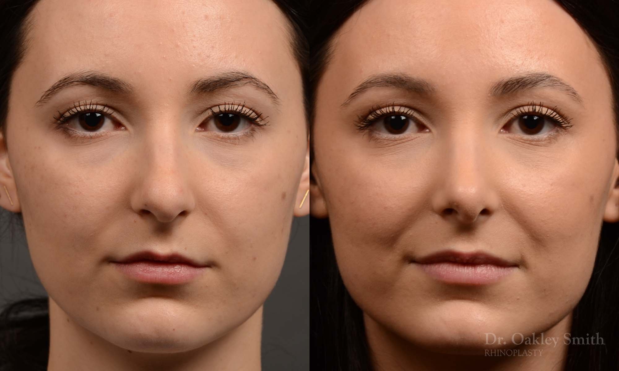 449 rhinoplasty, dr oakley smith, toronto, top surgeon, rhino, nose job