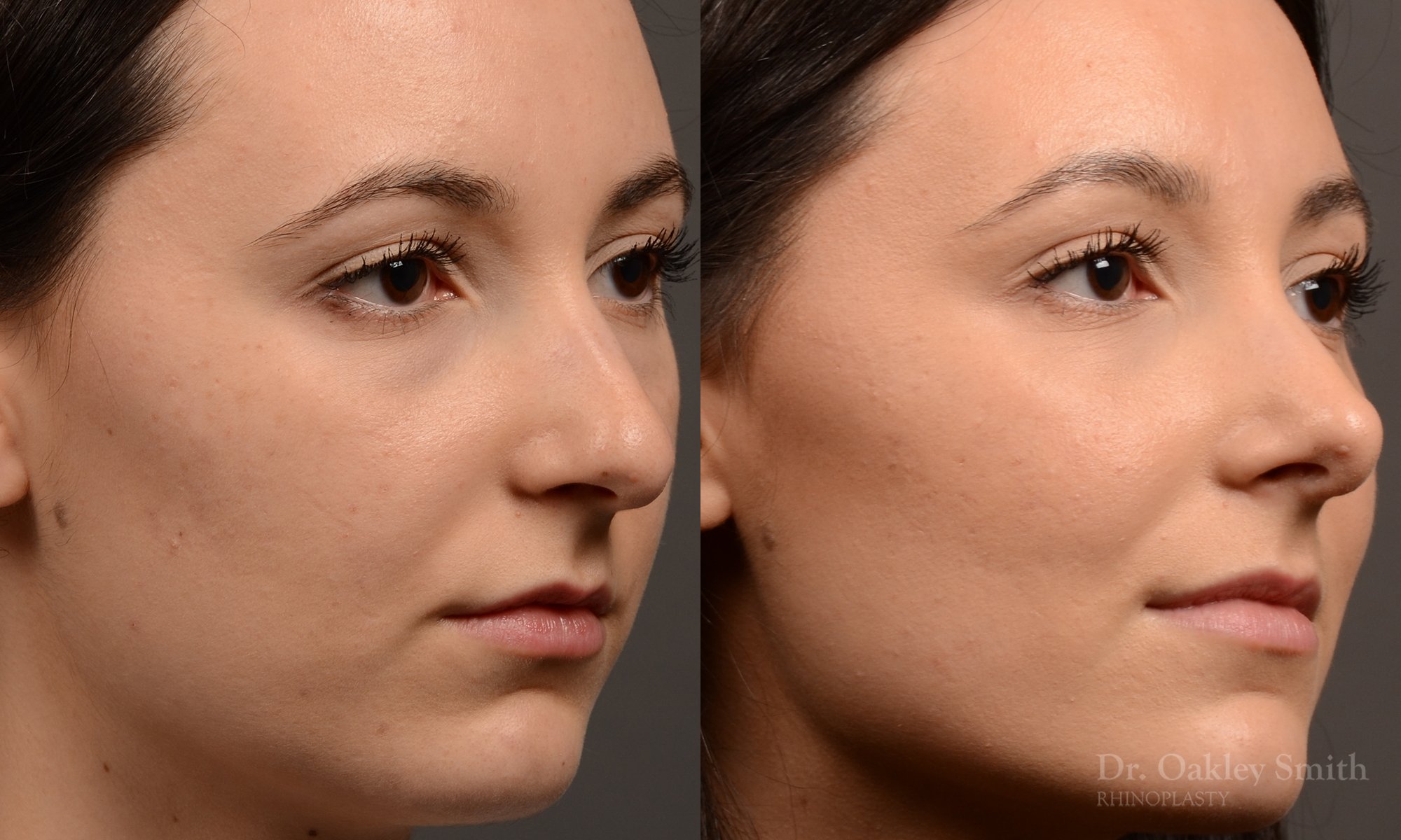 449 rhinoplasty, dr oakley smith, toronto, top surgeon, rhino, nose job