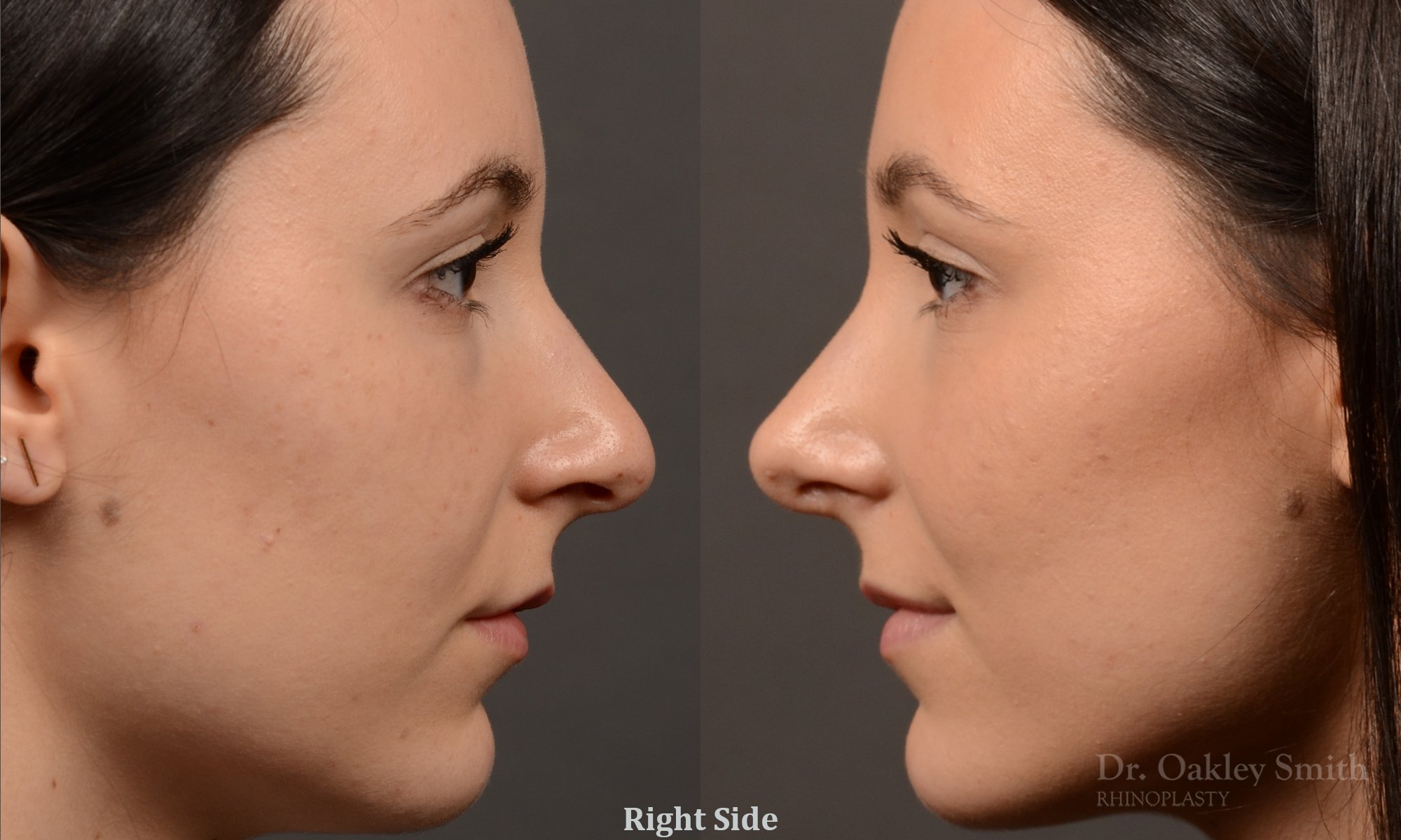 449 rhinoplasty, dr oakley smith, toronto, top surgeon, rhino, nose job