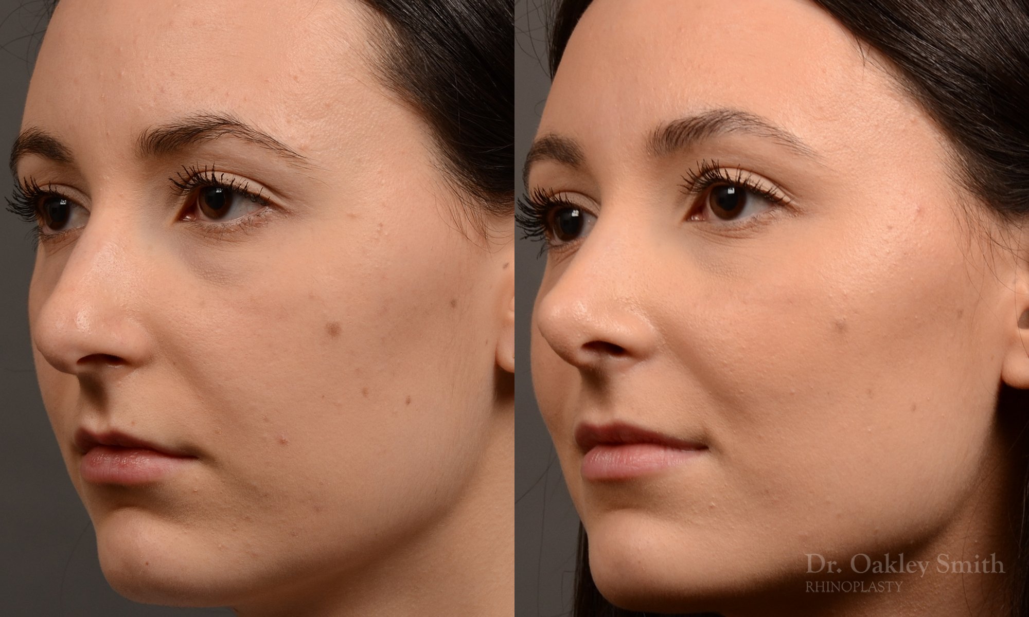 449 rhinoplasty, dr oakley smith, toronto, top surgeon, rhino, nose job