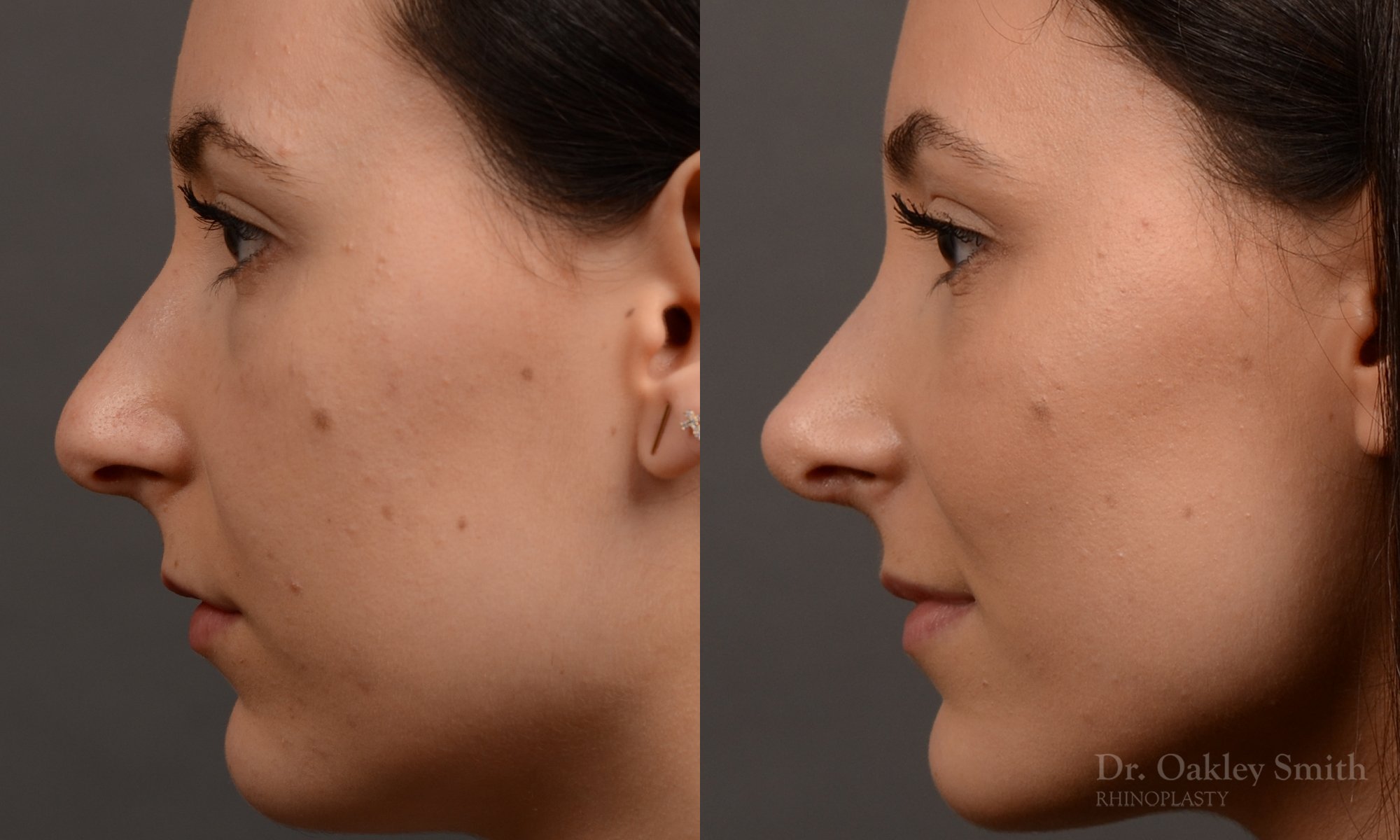 449 rhinoplasty, dr oakley smith, toronto, top surgeon, rhino, nose job