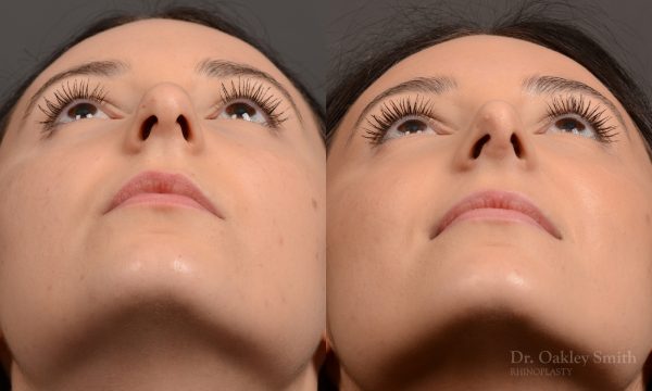 449 rhinoplasty, dr oakley smith, toronto, top surgeon, rhino, nose job