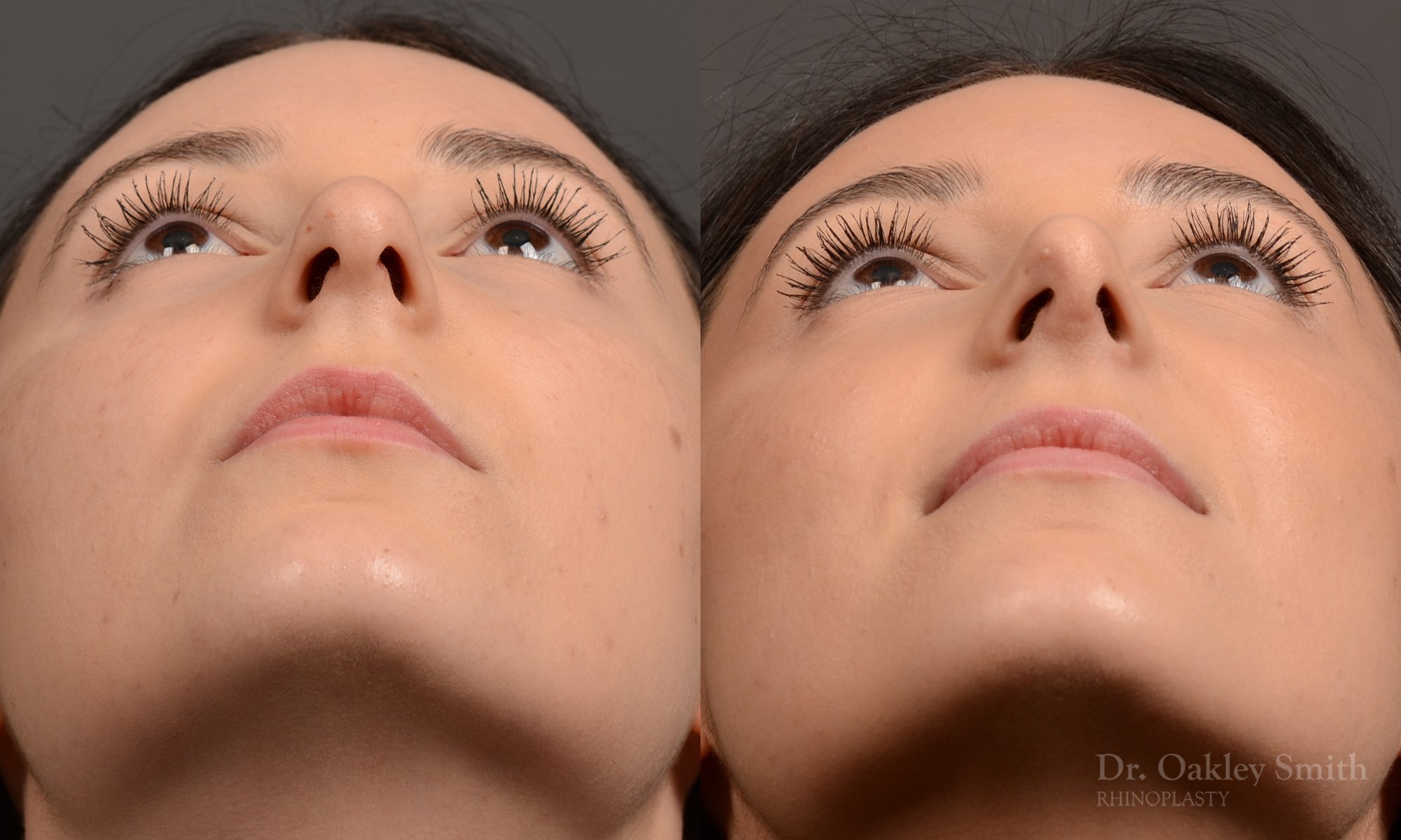 449 rhinoplasty, dr oakley smith, toronto, top surgeon, rhino, nose job