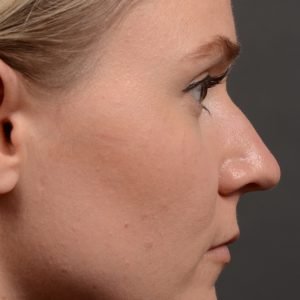 437 rhinoplasty, dr oakley smith, toronto, top surgeon, nose job