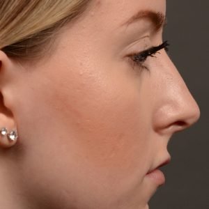 450 rhinoplasty, dr oakley smith, toronto, top surgeon, nose job