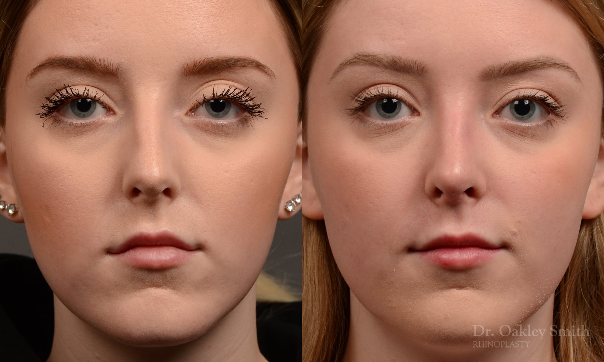 450 rhinoplasty, dr oakley smith, toronto, top surgeon, nose job