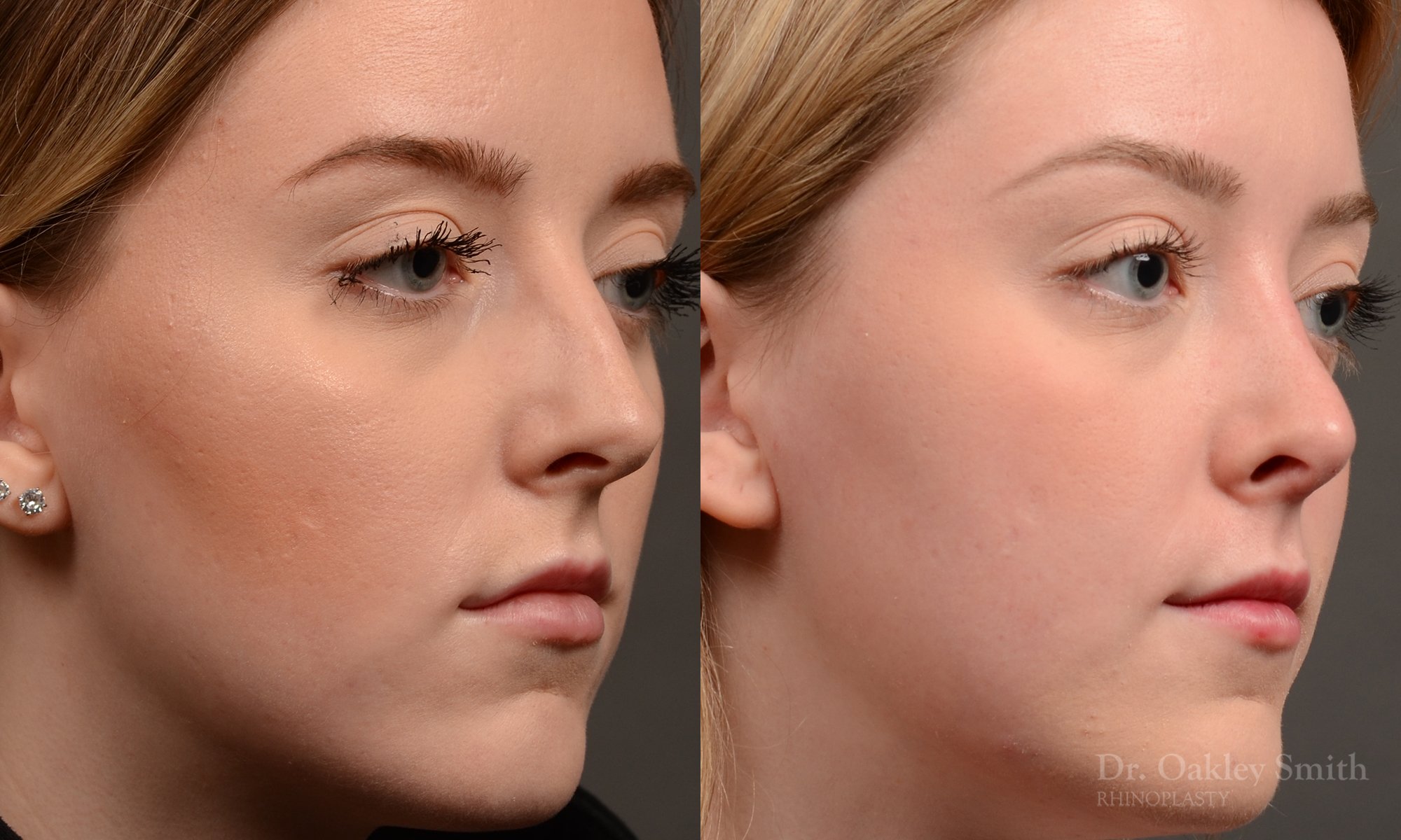 450 rhinoplasty, dr oakley smith, toronto, top surgeon, nose job
