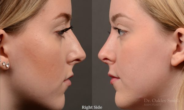 450 rhinoplasty, dr oakley smith, toronto, top surgeon, nose job