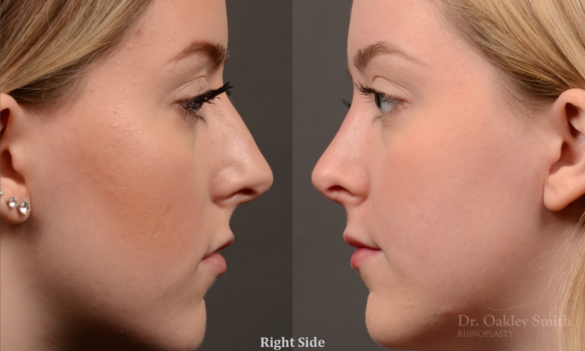 450 rhinoplasty, dr oakley smith, toronto, top surgeon, nose job