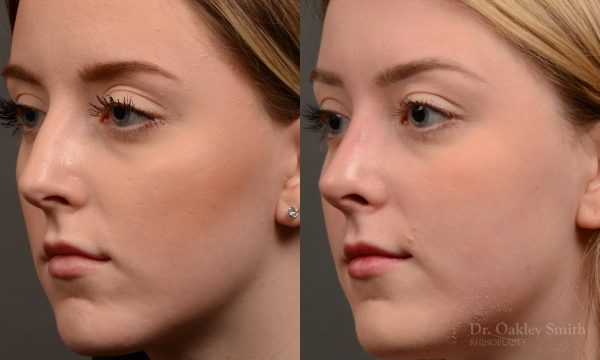 450 rhinoplasty, dr oakley smith, toronto, top surgeon, nose job