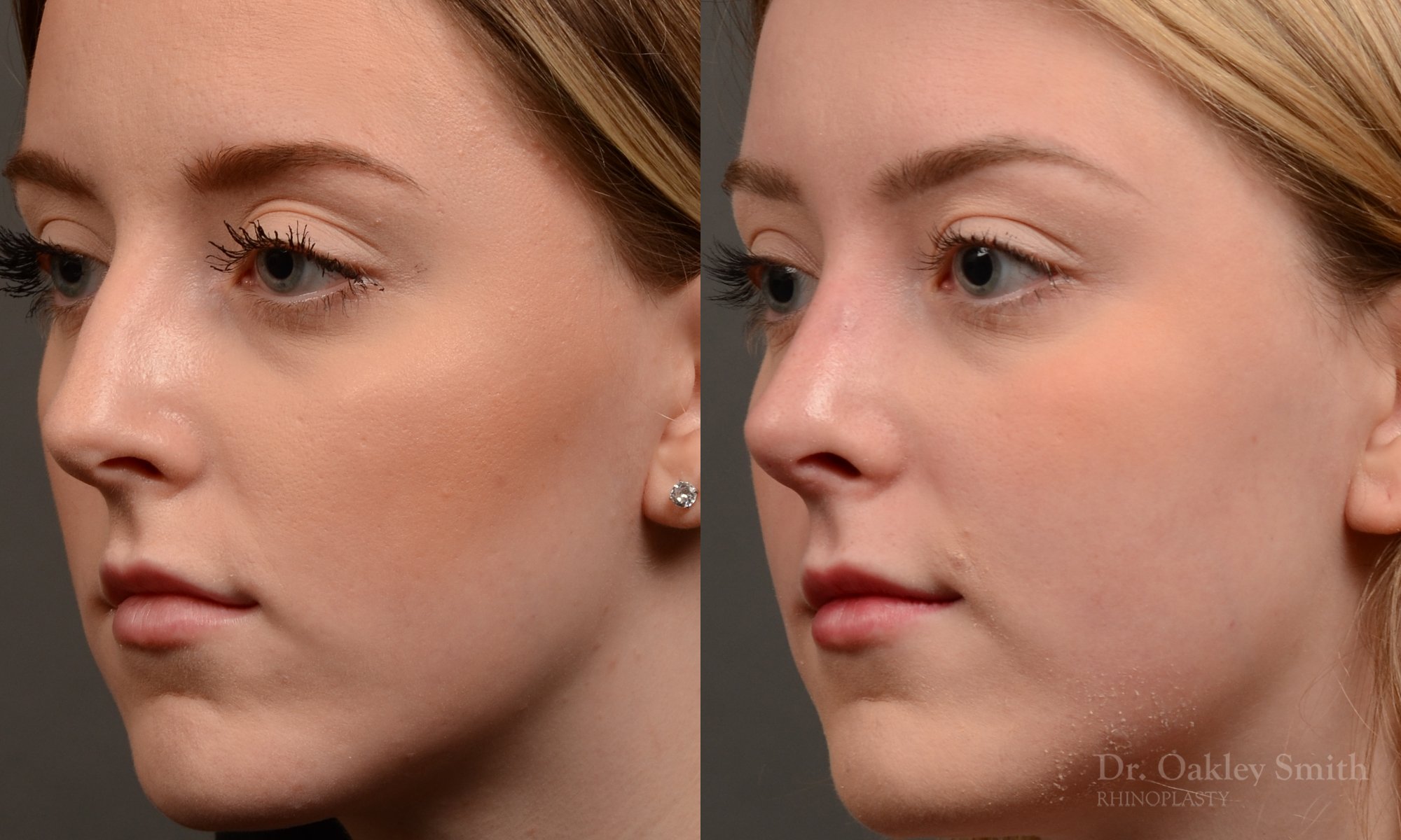 450 rhinoplasty, dr oakley smith, toronto, top surgeon, nose job
