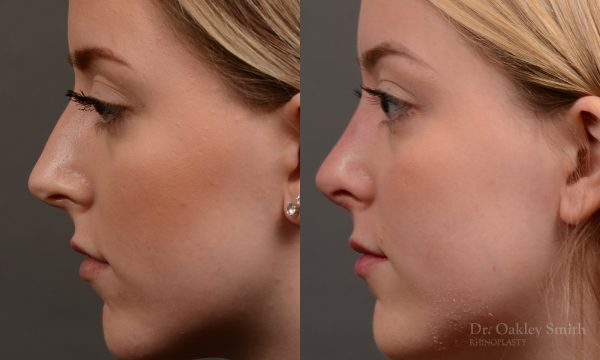450 rhinoplasty, dr oakley smith, toronto, top surgeon, nose job