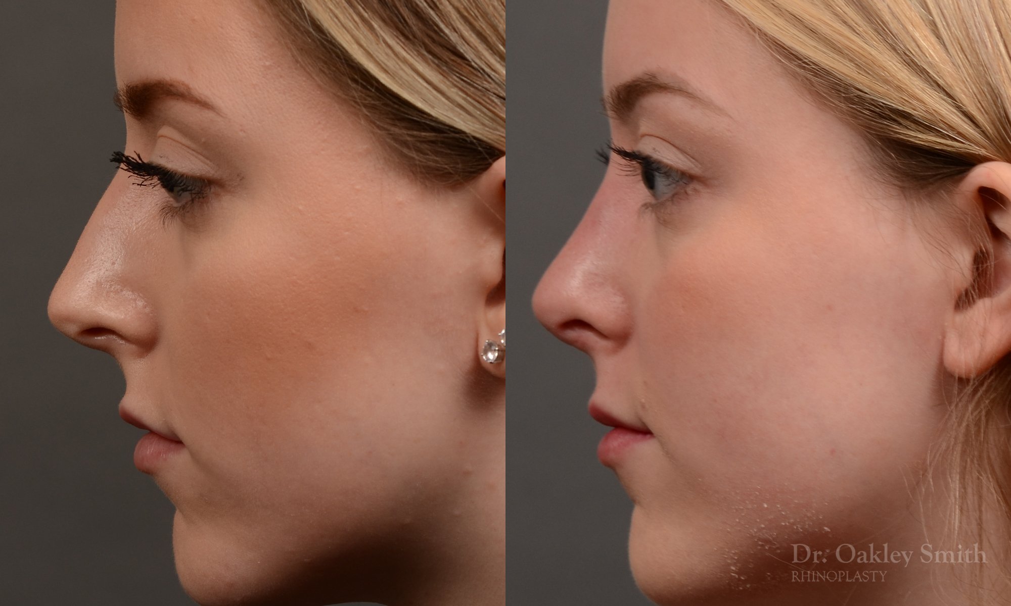 450 rhinoplasty, dr oakley smith, toronto, top surgeon, nose job